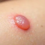 Kiedy kurzajka umiera? Procesy i objawy gojenia